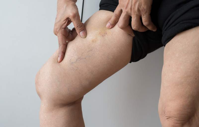 Combien de temps dure une thrombose veineuse profonde ?
